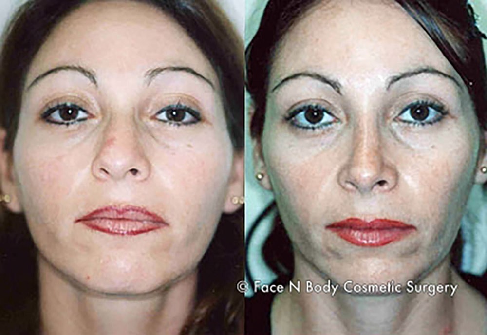 Rhinoplasty Before & After