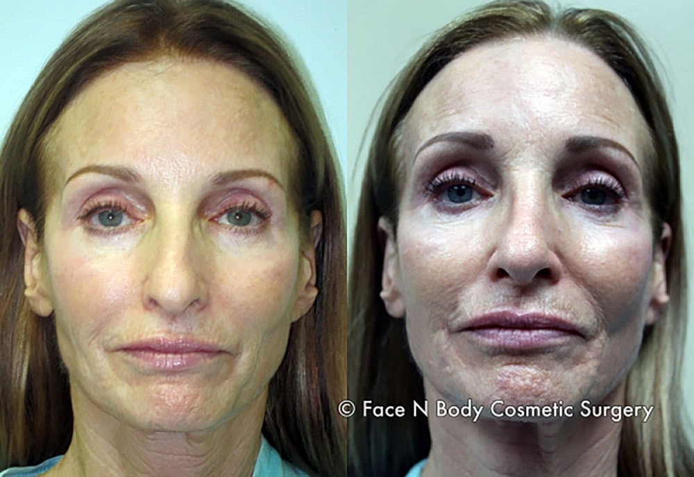 Rhinoplasty Before & After