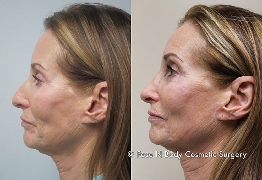 Rhinoplasty Before & After