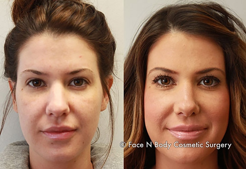 Rhinoplasty Before & After