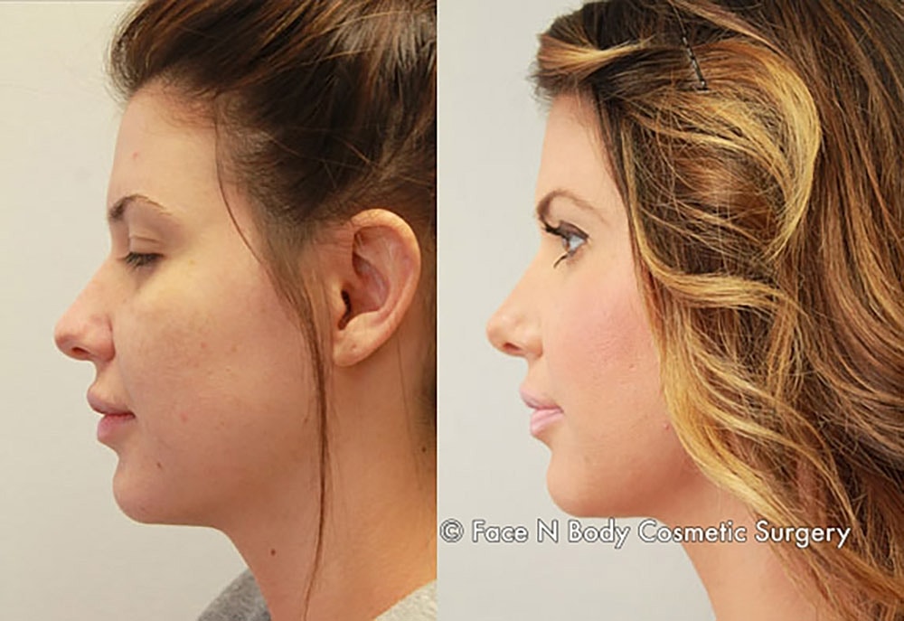 Rhinoplasty Before & After
