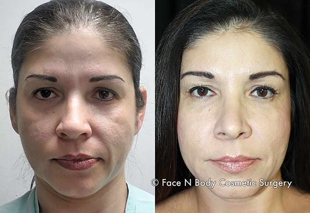 Rhinoplasty Before & After