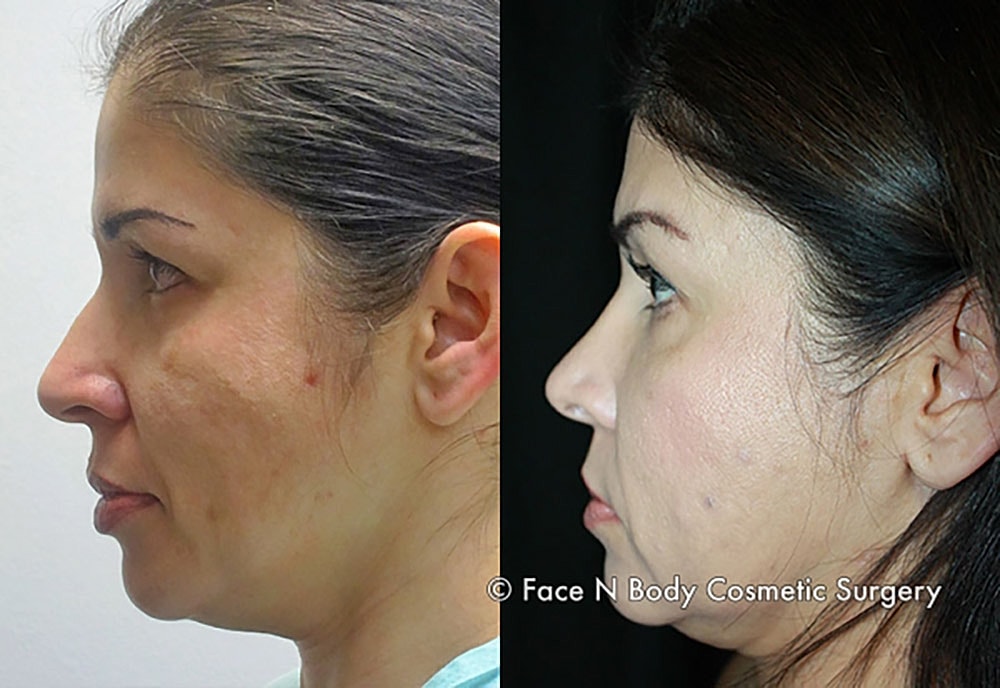 Rhinoplasty Before & After