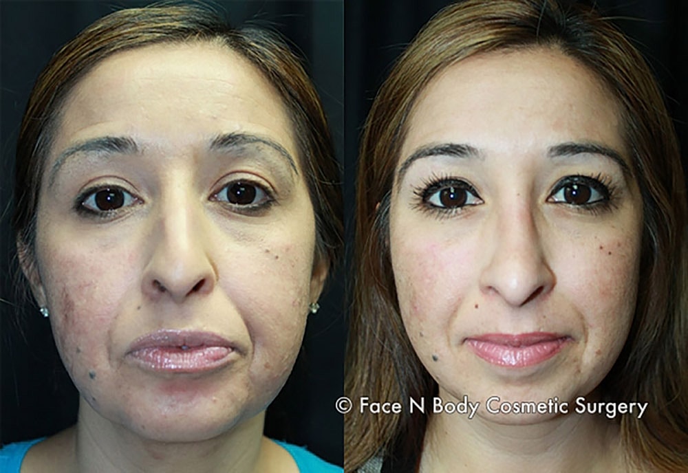 Rhinoplasty Before & After
