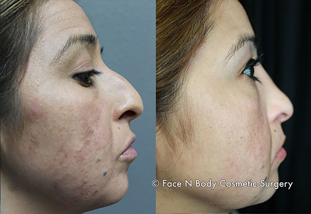 Rhinoplasty Before & After