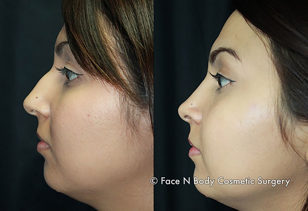 Rhinoplasty Before & After