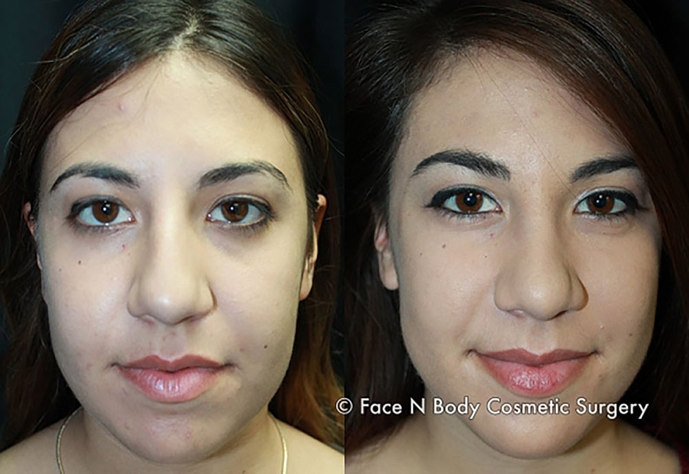 Rhinoplasty Before & After