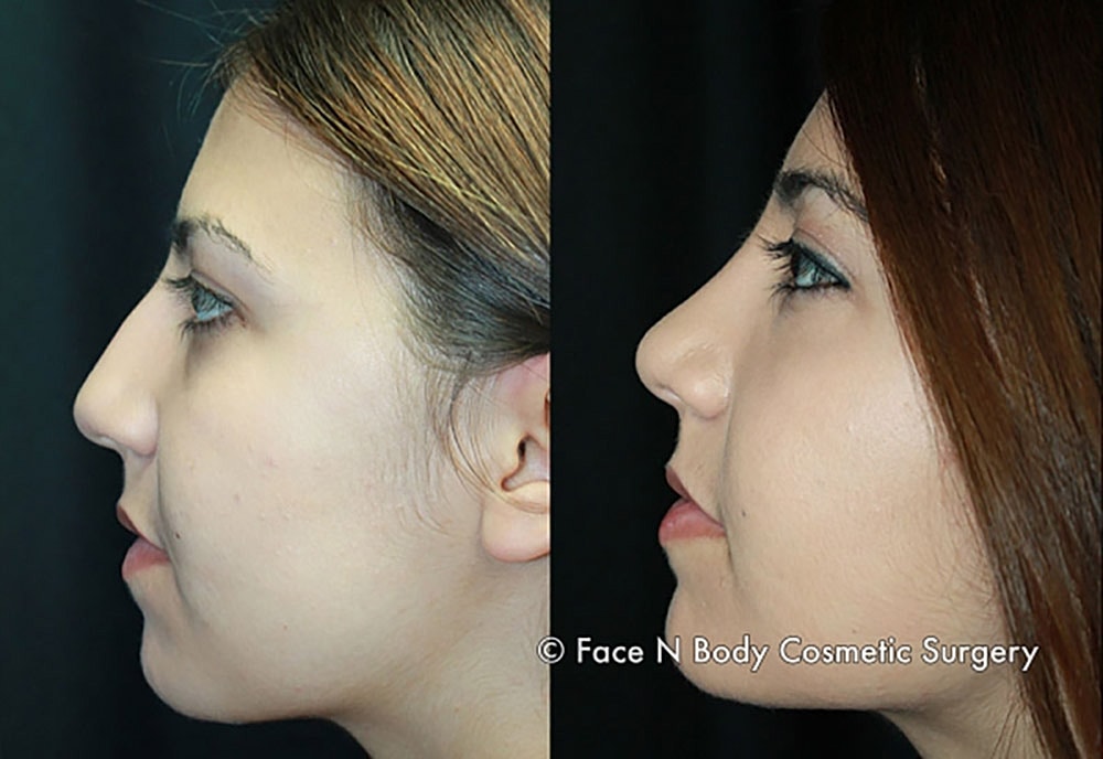 Rhinoplasty Before & After