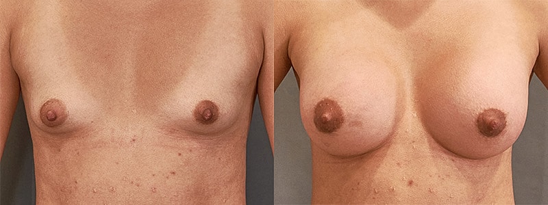 Breast Augmentation Before & After