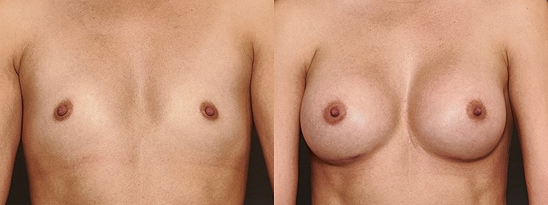Breast Augmentation Before & After