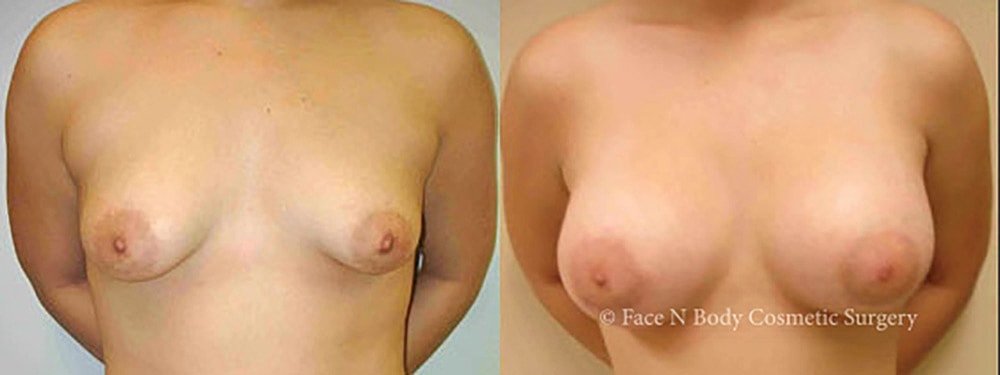 Breast Augmentation Before & After
