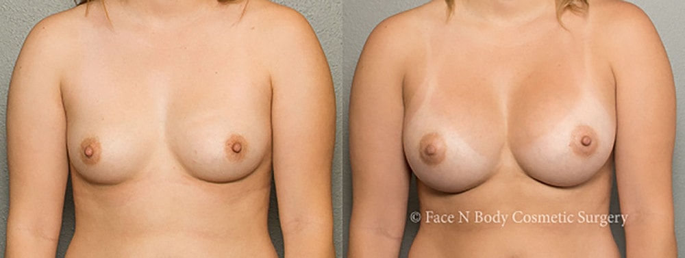 Breast Augmentation Before & After