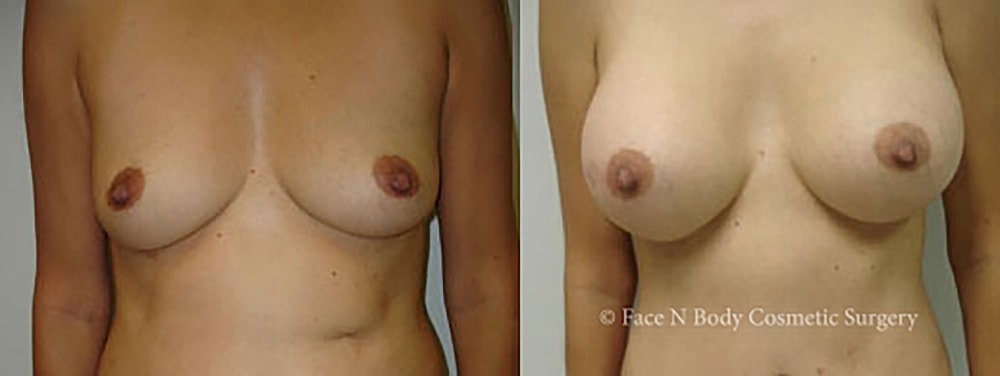 Breast Augmentation Before & After