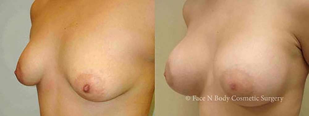 Breast Augmentation Before & After