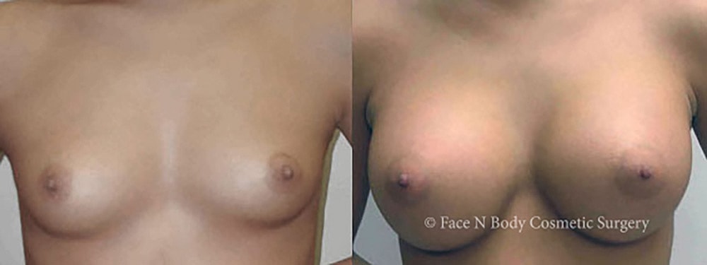 Breast Augmentation Before & After