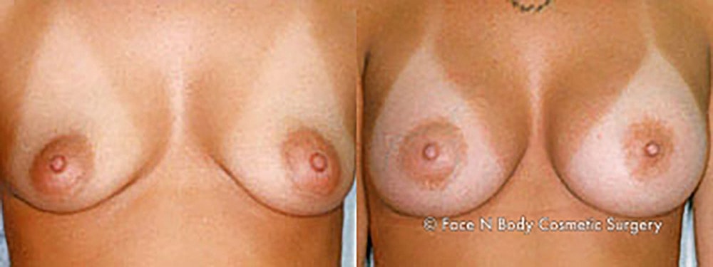 Breast Augmentation Before & After