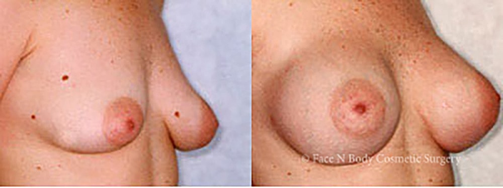 Breast Augmentation Before & After