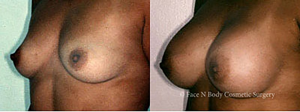 Breast Augmentation Before & After