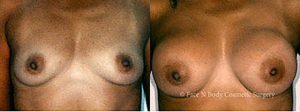 Breast Augmentation Before & After