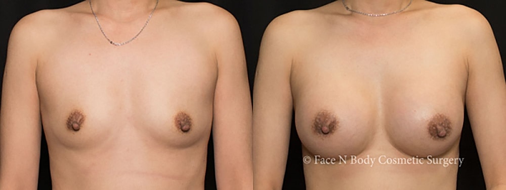 Breast Augmentation Before & After