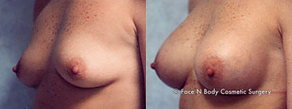 Breast Augmentation Before & After