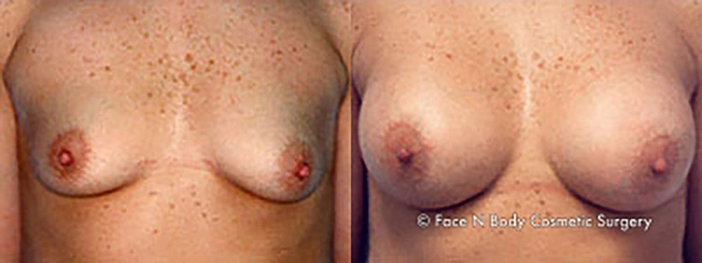 Breast Augmentation Before & After