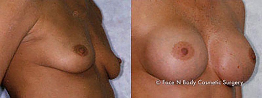 Breast Augmentation Before & After