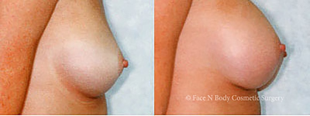 Breast Augmentation Before & After