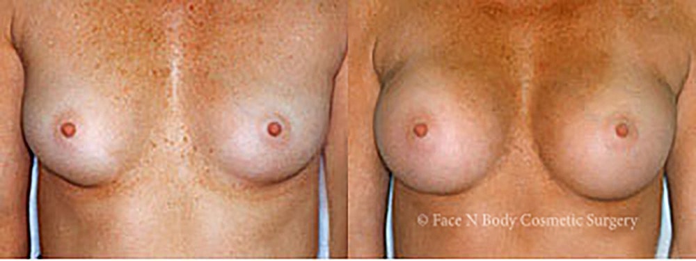 Breast Augmentation Before & After