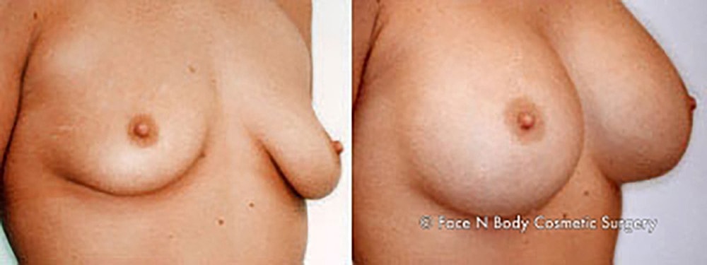 Breast Augmentation Before & After