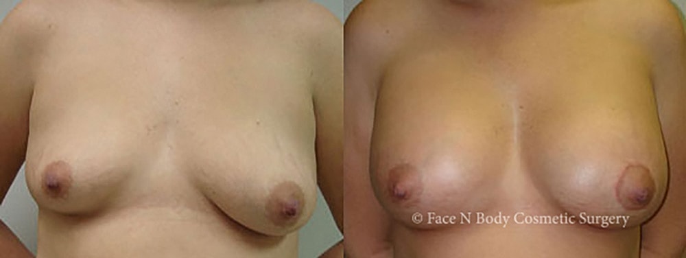 Breast Augmentation Before & After