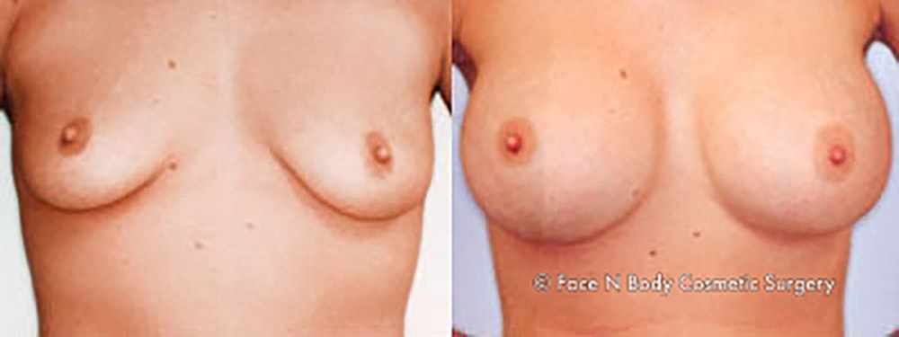 Breast Augmentation Before & After