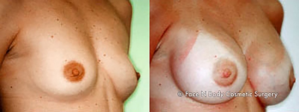Breast Augmentation Before & After