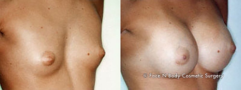 Breast Augmentation Before & After