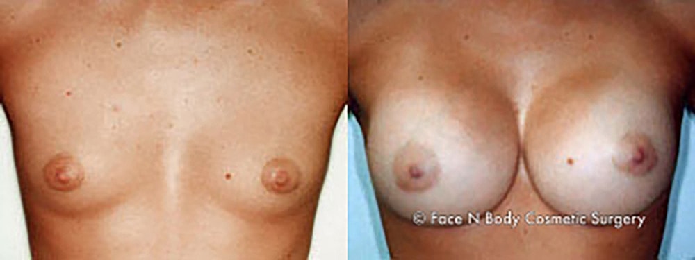 Breast Augmentation Before & After
