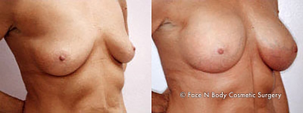 Breast Augmentation Before & After