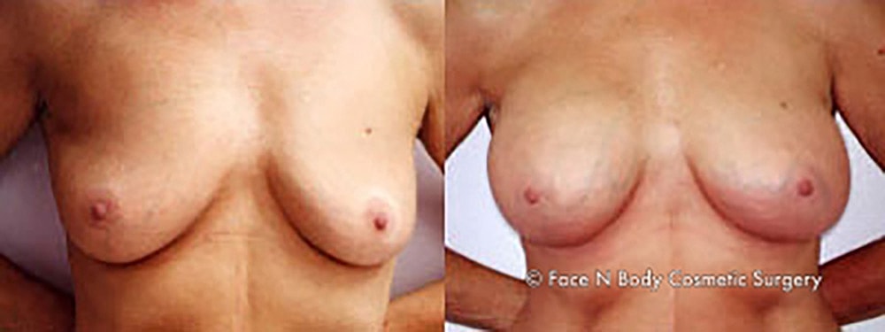 Breast Augmentation Before & After
