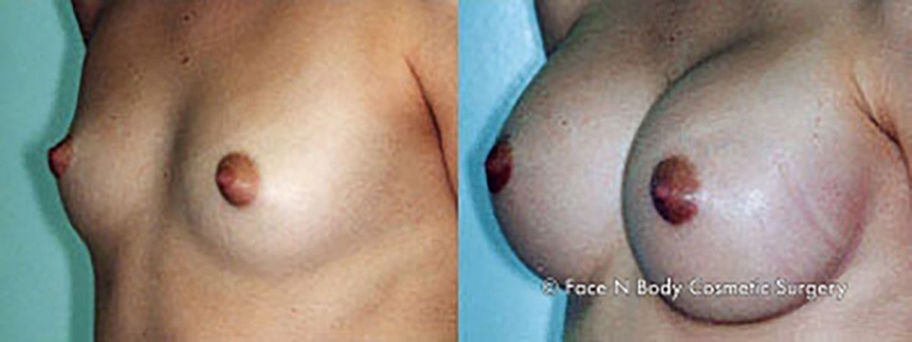Breast Augmentation Before & After