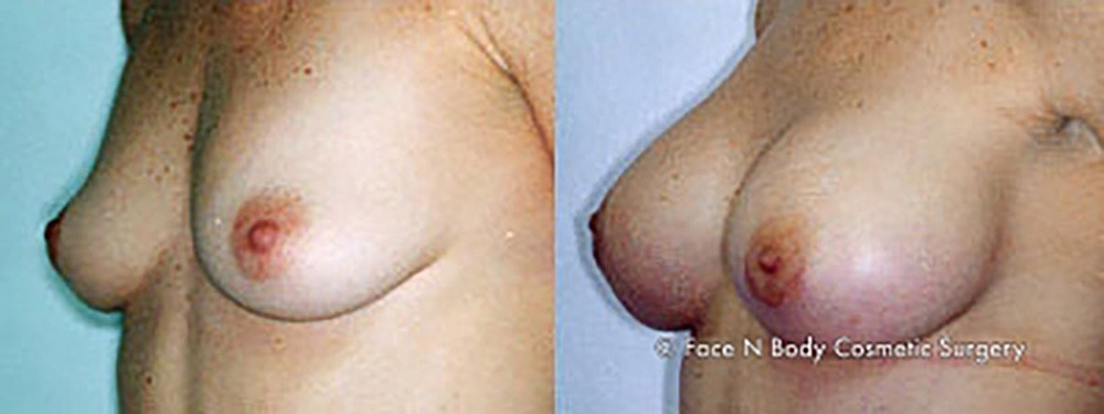 Breast Augmentation Before & After
