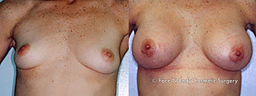 Breast Augmentation Before & After