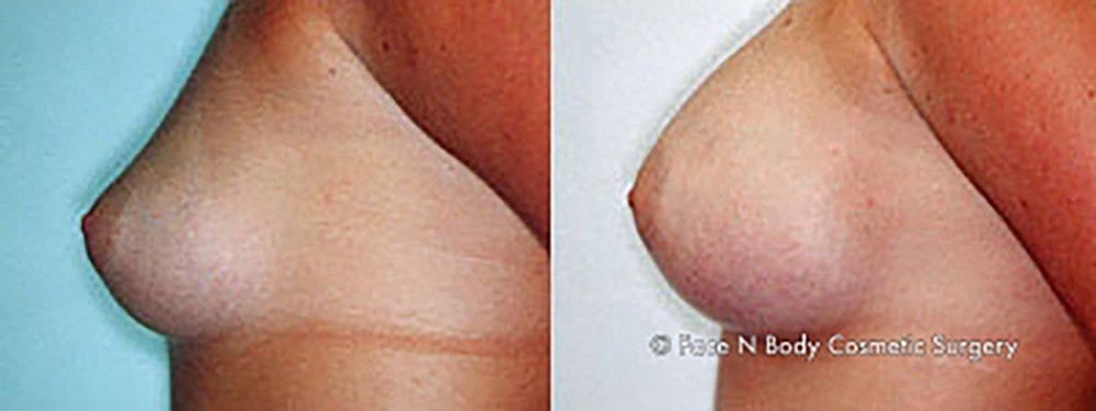 Breast Augmentation Before & After