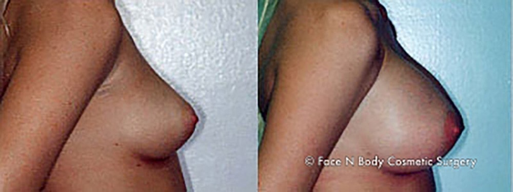 Breast Augmentation Before & After
