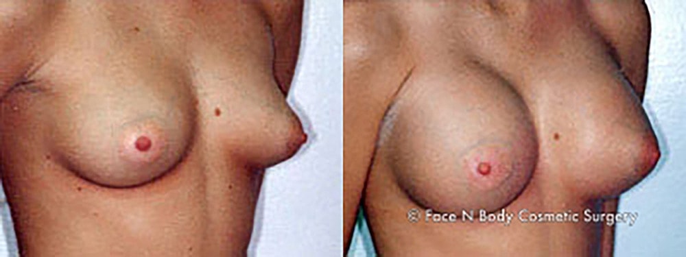 Breast Augmentation Before & After