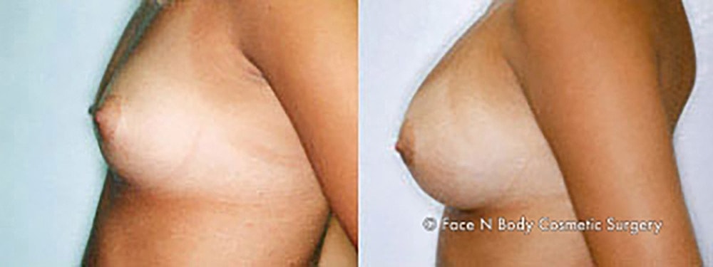 Breast Augmentation Before & After