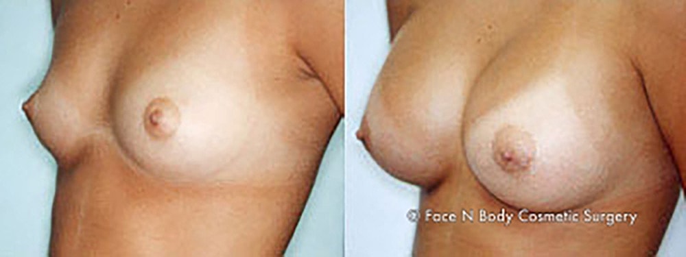 Breast Augmentation Before & After