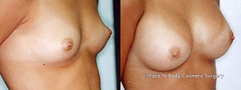 Breast Augmentation Before & After
