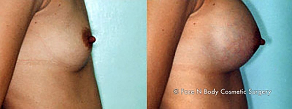 Breast Augmentation Before & After