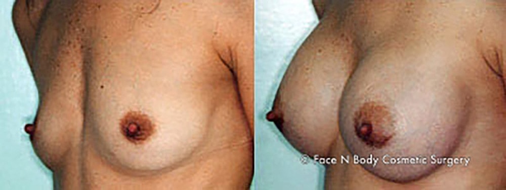 Breast Augmentation Before & After