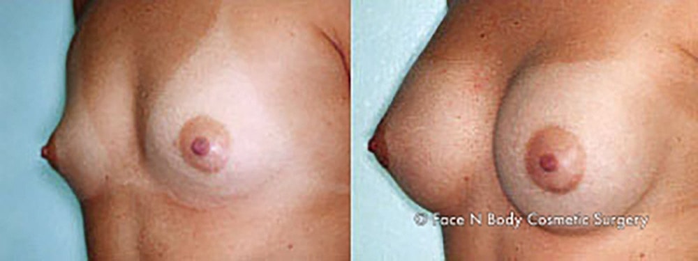 Breast Augmentation Before & After