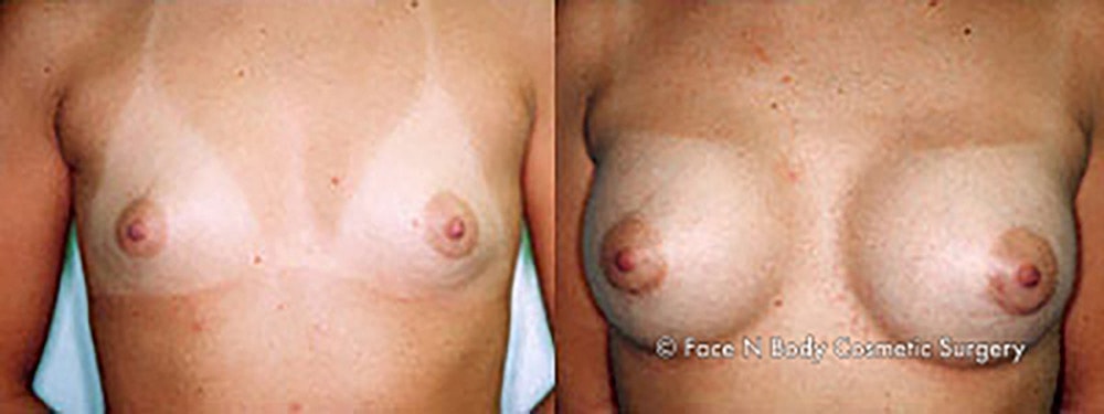 Breast Augmentation Before & After